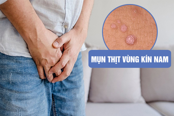 MỤN THỊT VÙNG KÍN NAM: NGUYÊN NHÂN VÀ CÁCH CHỮA TRỊ HIỆU QUẢ