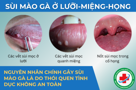 TÌM HIỂU BỆNH SÙI MÀO GÀ Ở LƯỠI, MIỆNG, HỌNG VÀ CÁCH CHỮA HIỆU QUẢ