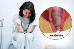 Tổng Quan Về Rò Hậu Môn. Rò Hậu Môn Dấu Hiệu & Cách Điều Trị Như Thế Nà