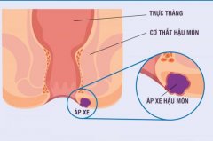 Apxe Hậu Môn: Triệu Chứng, Nguyên Nhân và Phương Pháp Điều Trị Hiệu Quả